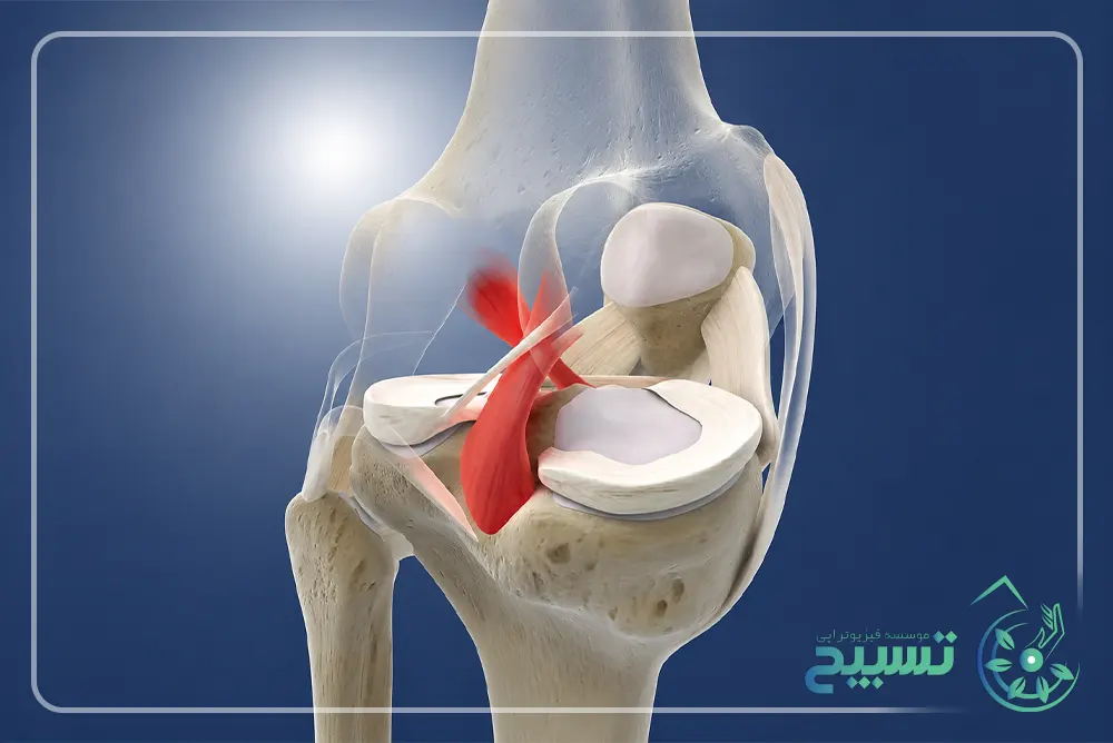 رباط صلیبی قدامی